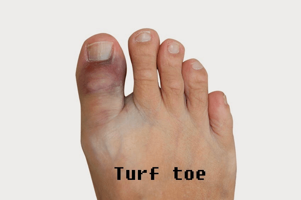 5 Common Causes of Turf Toe