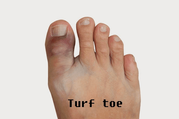5 Common Causes of Turf Toe - Human 2.0